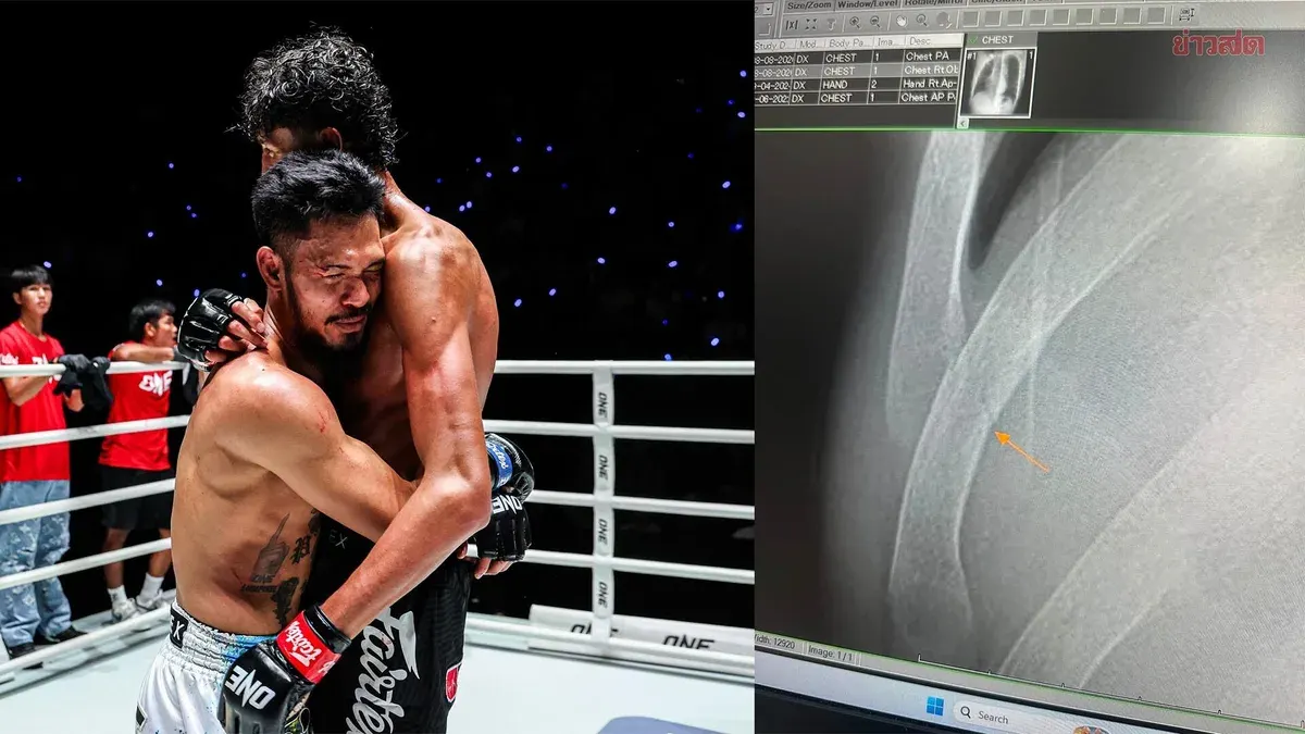 Muay Thai Fighter Sueakkim Sidelined Three Months With Broken Ribs