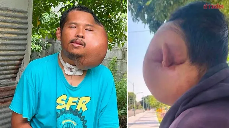 Man's Face Swells From Cavity and Toothpick, Attacked Online as AI Hoax