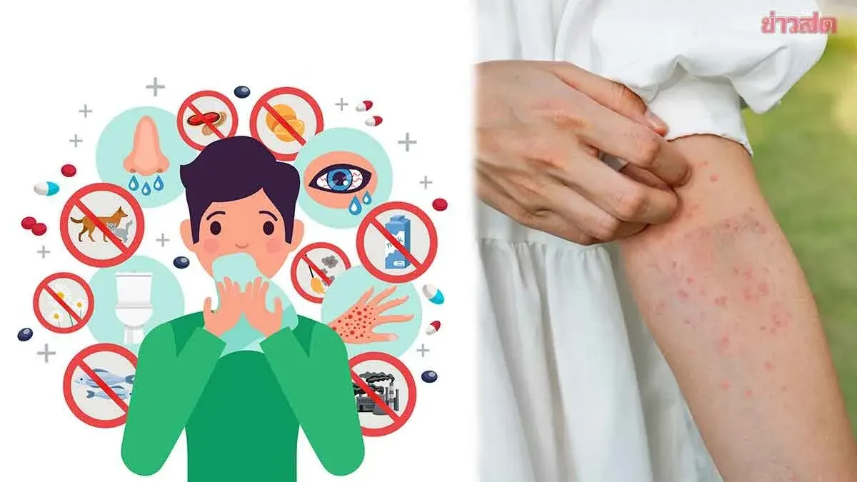 Thai Hospitals Identify Six Hidden Hives Triggers and Treatments