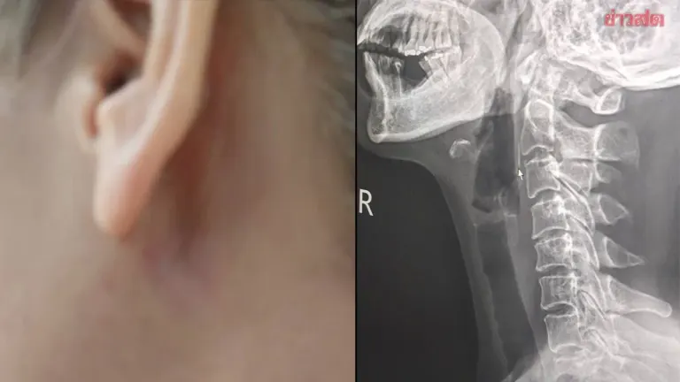 Woman Shares Horrifying Tale of Fish Bone Stuck in Throat for 11 Days—Thought It Moved Down, Then It Suddenly Pierce Through Her Neck