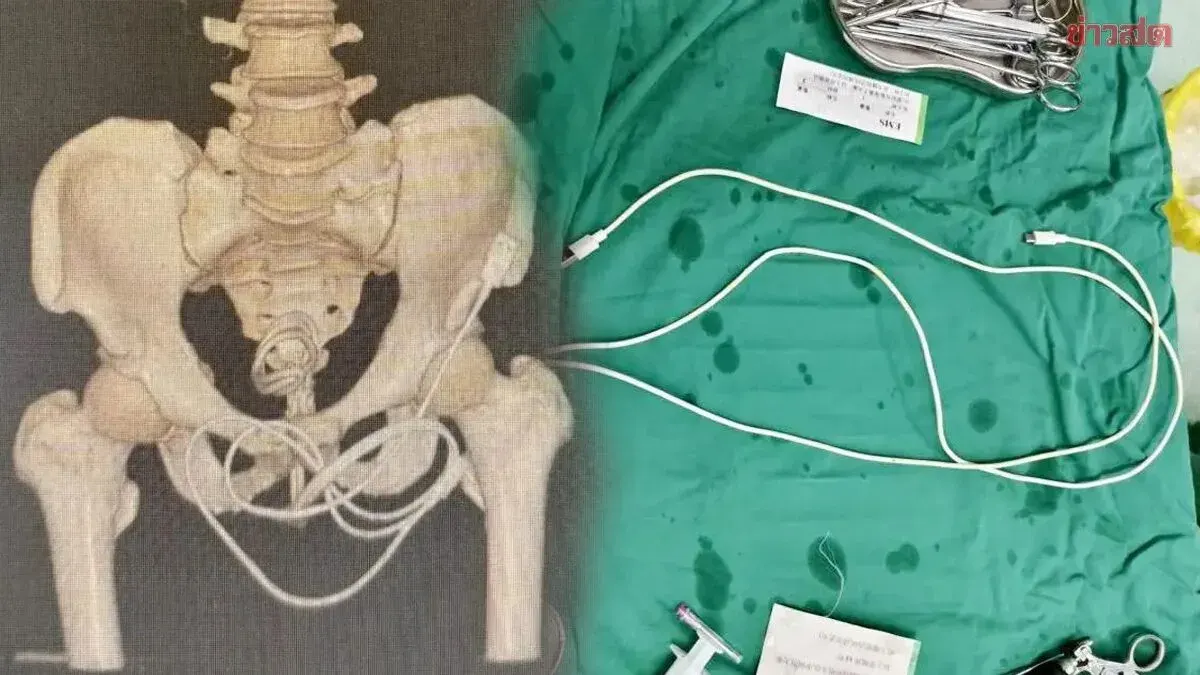 Chinese Man Requires Surgery After Inserting Charging Cable Into Urethra