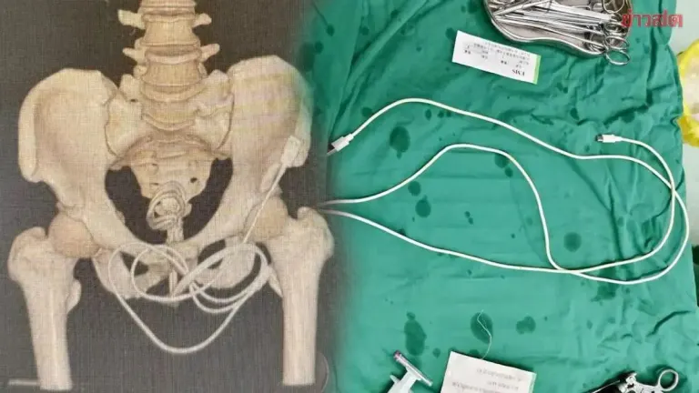 Chinese Man Requires Surgery After Inserting Charging Cable Into Urethra