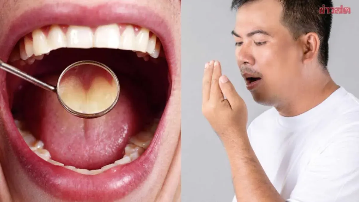 Doctor Reveals Why Bad Breath Persists Despite Daily Brushing, Offers 3 Prevention Methods and Warns of Tonsil Stones