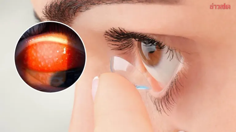 Eye Doctor Warns: Wearing Contacts Over 8 Hours Risks GPC