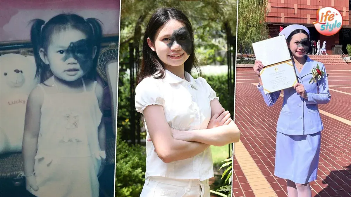 Birthmark Doesn't Define Her: Nurse's Inspiring Journey
