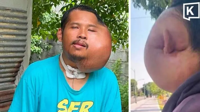Man With Severe Facial Swelling Denies AI Fake Claims