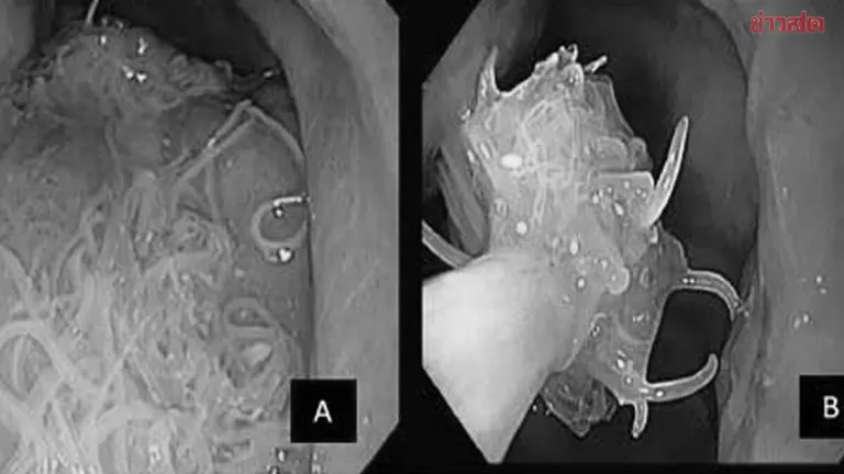 Woman Hospitalized With 140 Parasites After Eating Grilled Fish