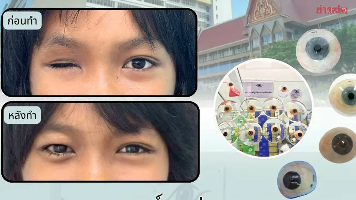 Metta Pracharaksa Hospital Now Offers Prosthetic Eyes Covered by Social Security, Aiming to Restore Confidence to Beneficiaries
