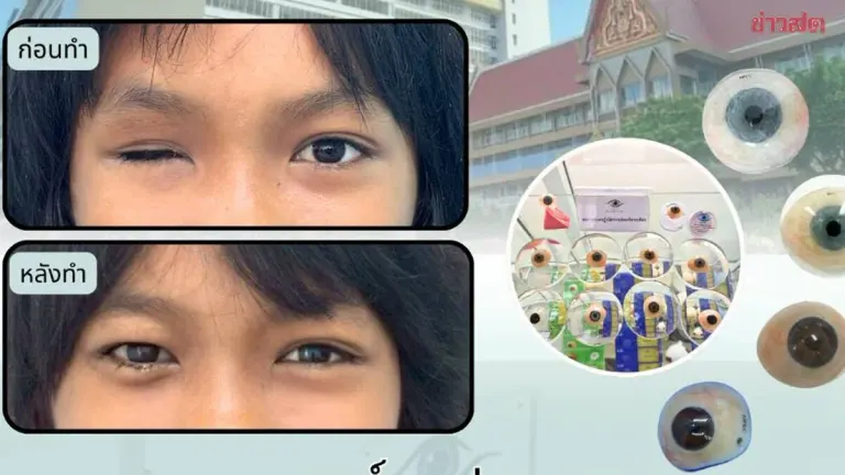 Metta Pracharaksa Hospital Now Offers Prosthetic Eyes Covered by Social Security, Aiming to Restore Confidence to Beneficiaries