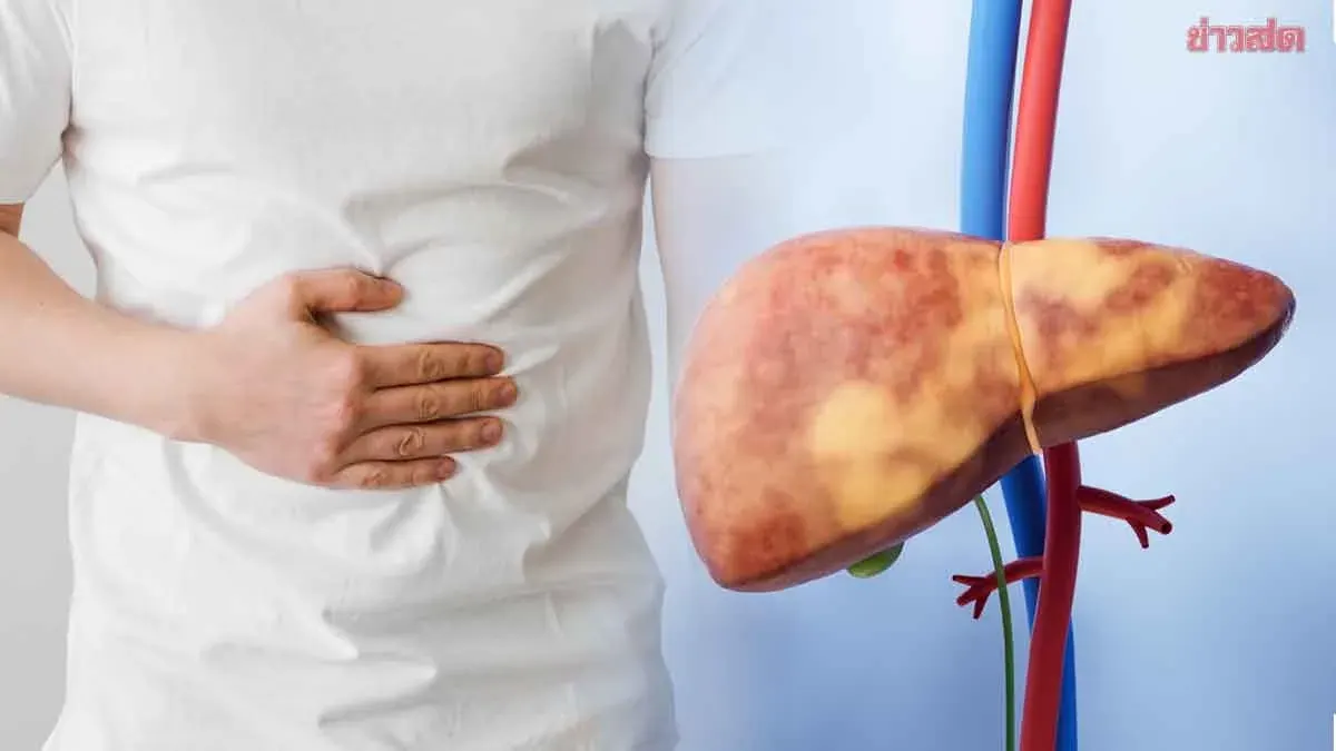 Doctor Warns of Silent Fatty Liver Disease Risks in Thailand